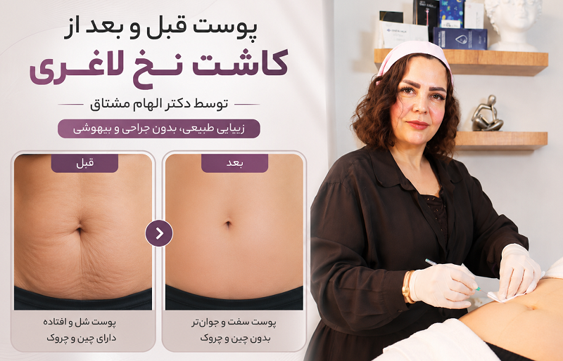 پوست قبل و بعد از کاشت نخ لاغری